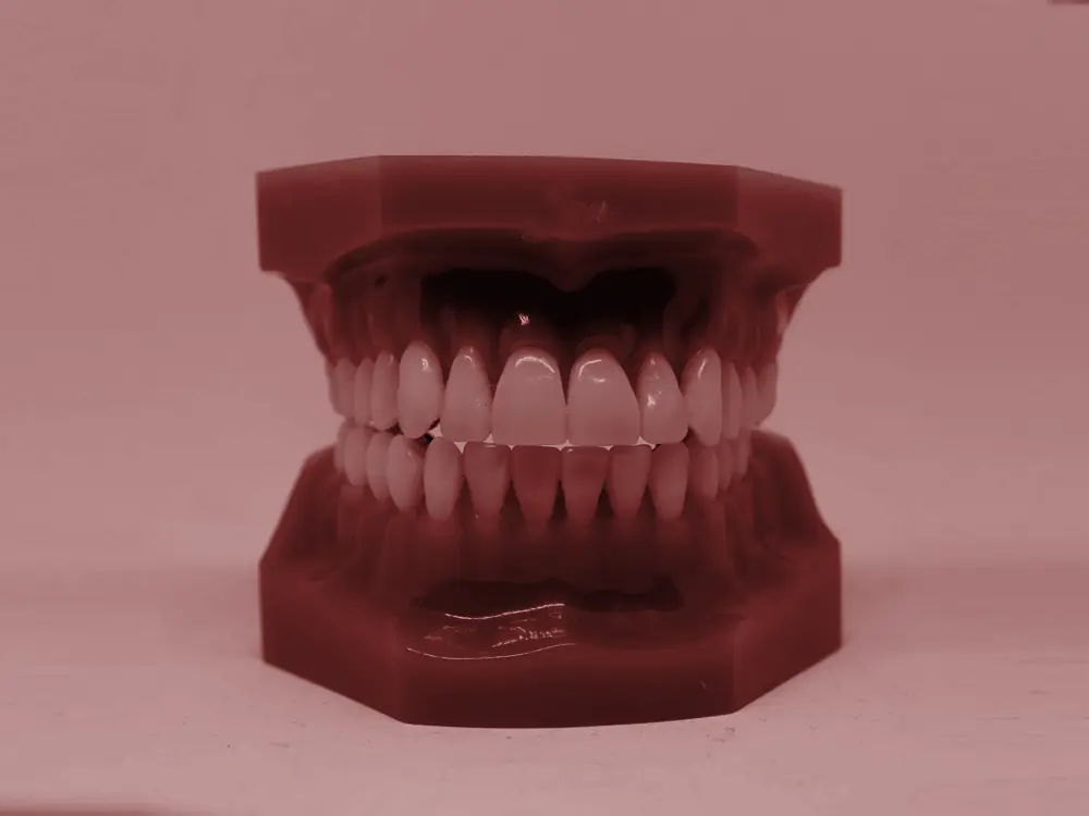 Dental model with metal braces bonded to the teeth