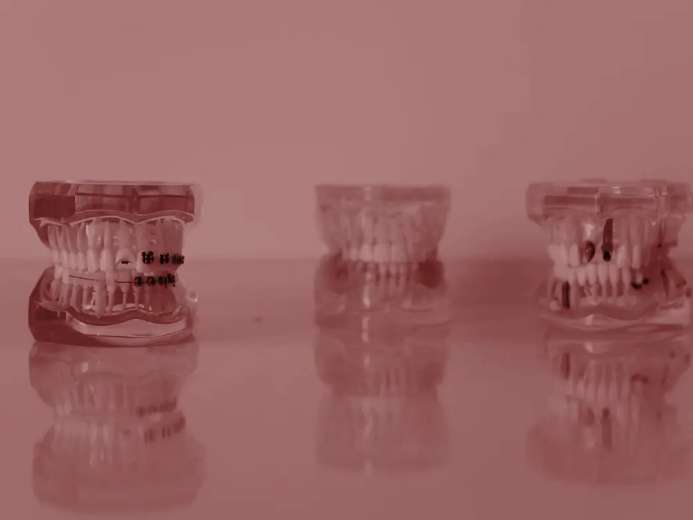 Three clear dental models showing braces on the teeth