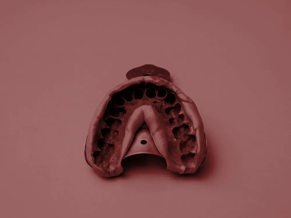 Dental impression tray with a fresh impression of the upper teeth