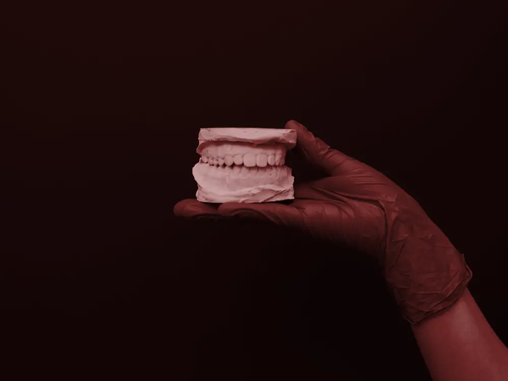 Gloved hand holding a plaster model of the teeth against a dark background