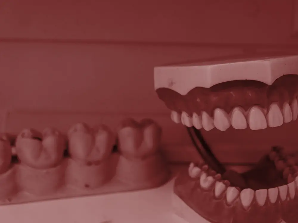 Two dental models showing upper and lower teeth