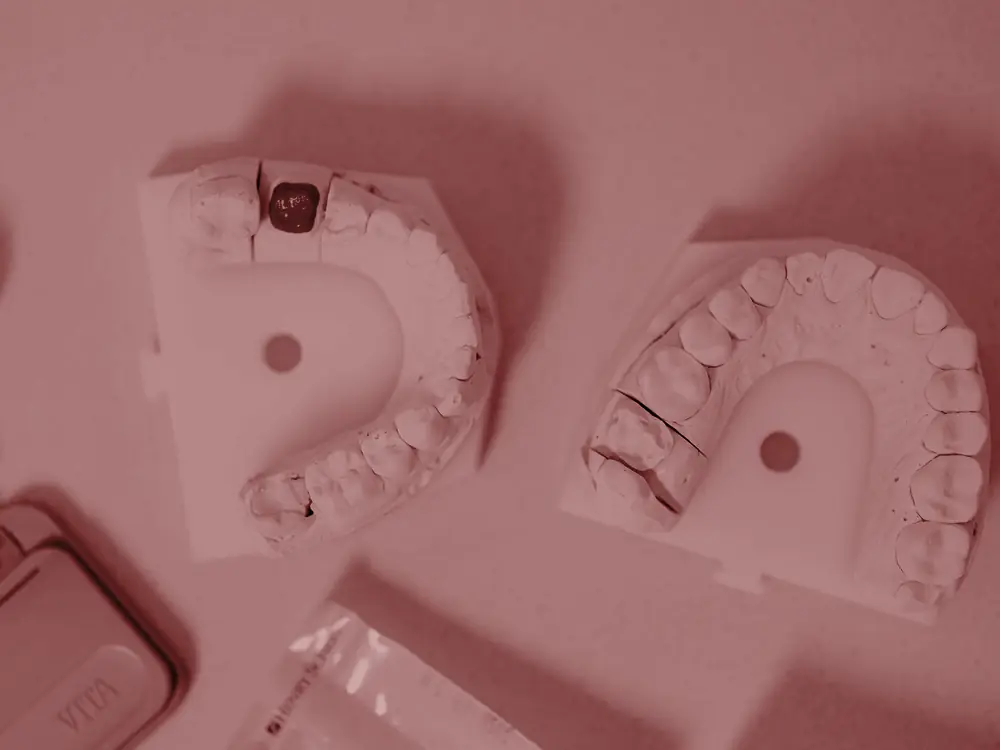 White dental models of the upper and lower arches