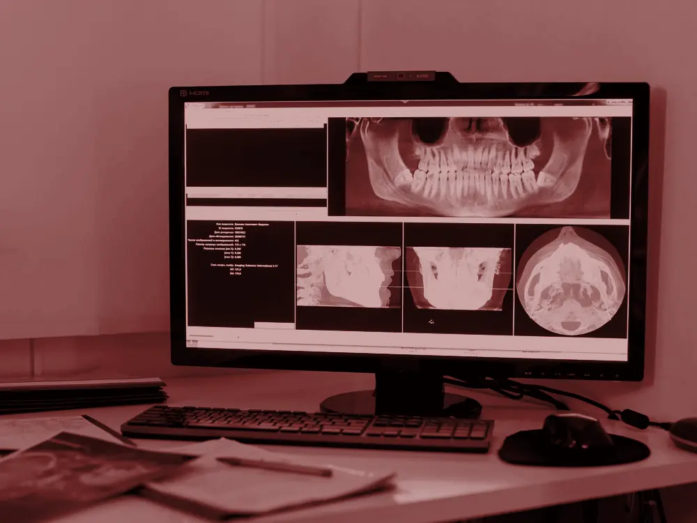 Dental x-ray displayed on a computer monitor