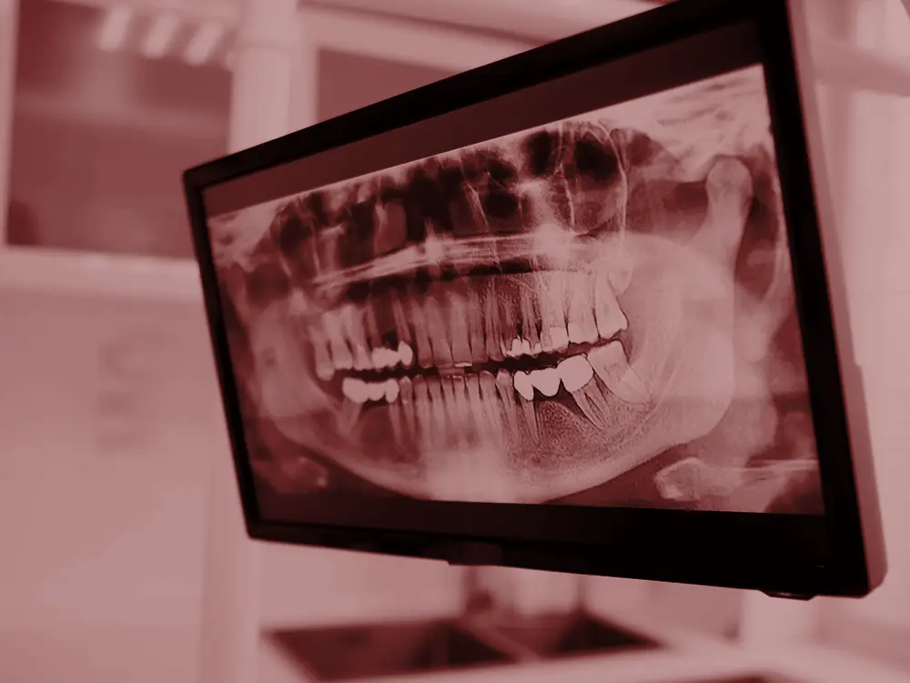 Panoramic dental x-ray on a screen in a clinic
