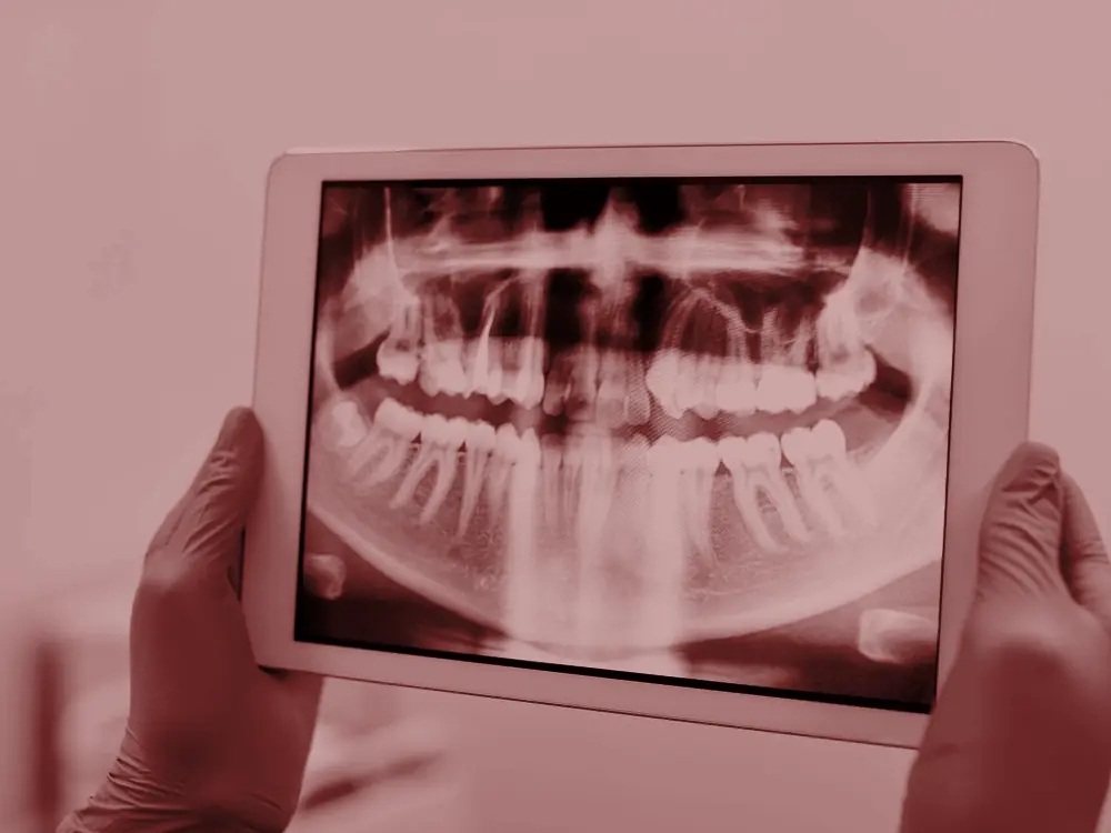 Gloved hands holding a tablet showing a dental x-ray